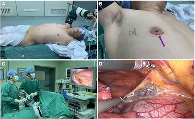 Transareolar uniportal thoracoscopic extended thymectomy for patients with myasthenia gravis